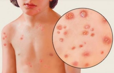 Home remedies to cure chicken pox