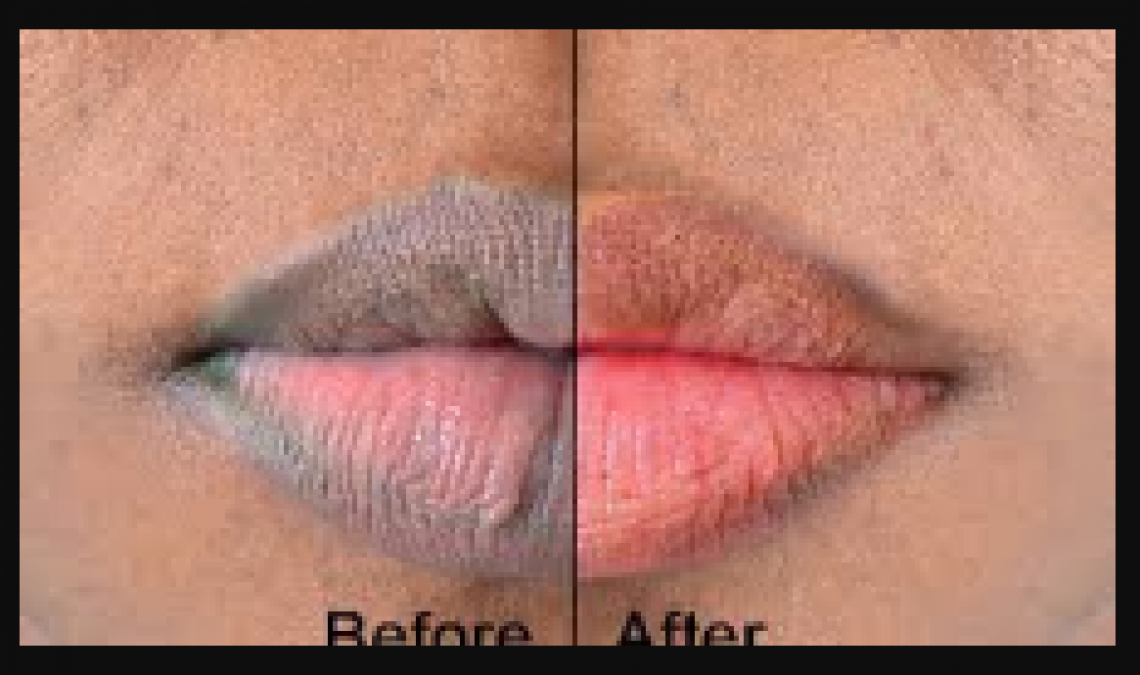 Get Rid Of Black Lips In Just Two Days With This Amazing Remedies Newstrack English 1