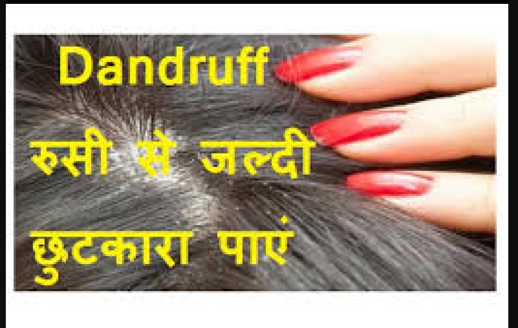 Follow this home remedy to remove dandruff | NewsTrack English 1