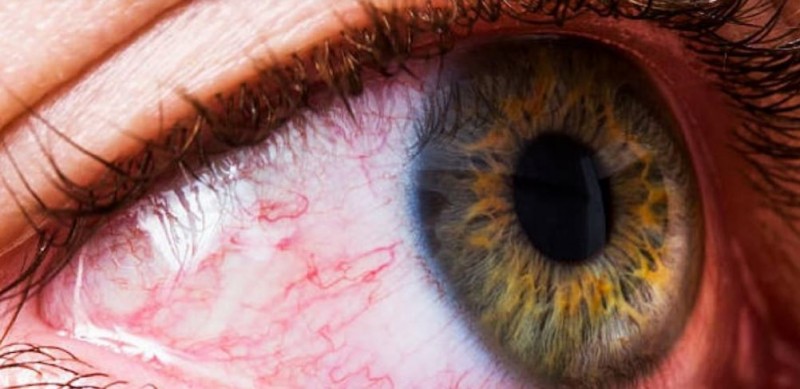 These 7 symptoms that appear in eyes can be a sign of Omicron