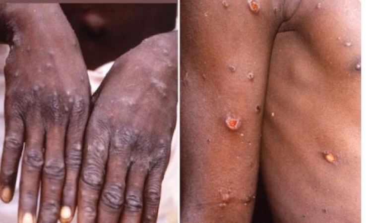 Some antiviral drugs may be beneficial in the treatment of monkeypox!