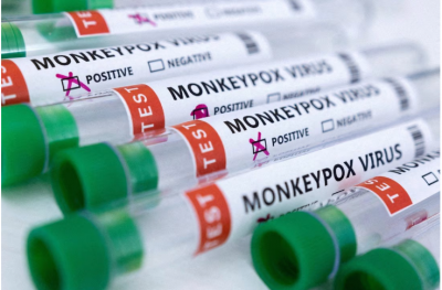 A monkeypox patient in the US passes away this may be the first death in the nation