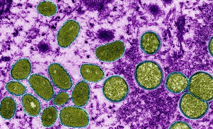 Health Expert shares insight: Can monkeypox spread via sex?