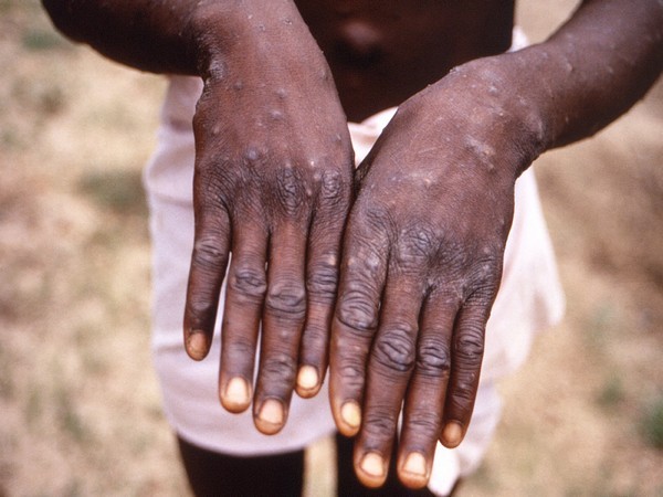 Tanzania issues monkeypox alert after an outbreak in Europe