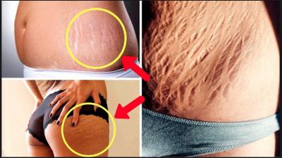 Most Amazing Home Remedies to Get Rid of Stretch Marks Naturally & Quickly
