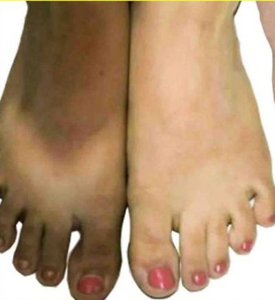 Dark ankle: Follow these simple homemade remedies to lighten up