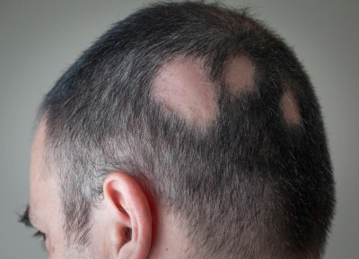 Dealing with Alopecia Areata: Recognize, Cope, and Thrive