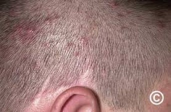 How to Effectively Manage Folliculitis of the Scalp