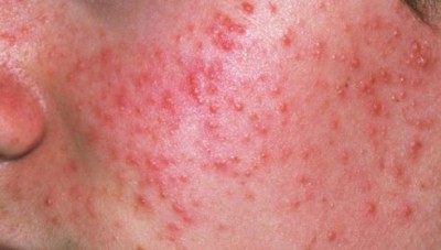 6 Ayurvedic ways to treat Acne