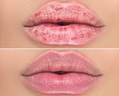 Make dry lips soft like this