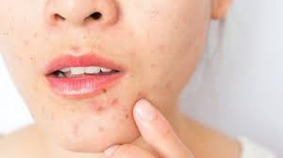 If pimples appear on the face again and again, then these could be the reasons behind it