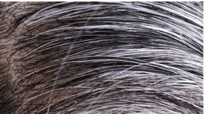 If you are troubled by gray hair at young age, then get rid of it with these easy remedies