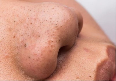 Follow these home remedies to remove stubborn blackheads