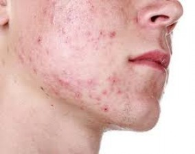 Do not mistake dry pimples on the skin for pimples, it can lead to serious illness