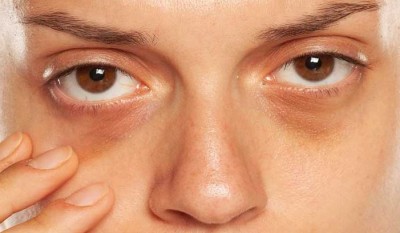 How to Get Rid of Dark Circles Under the Eyes: Try These 3 Tips