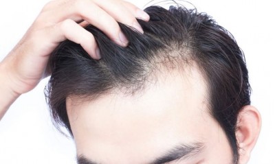 Take Immediate Action to Avoid These Factors or Risk Premature Baldness in Youth