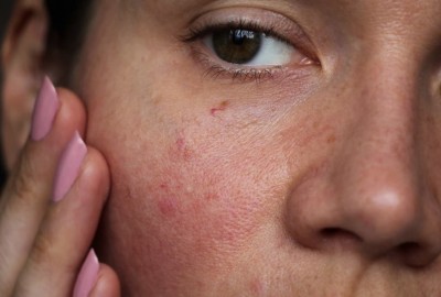 If your sensitive skin is getting irritated then do these things