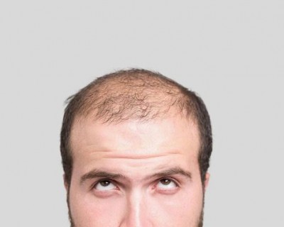 Male Baldness: Ayurvedic ways to get rid of it