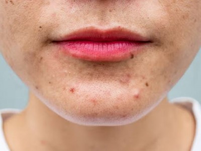 Why do pimples appear again and again on the face?