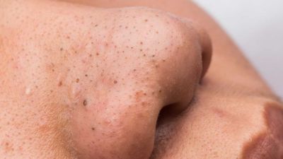 5 Easy steps to remove your blackheads at home