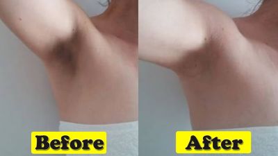 5 Home remedies for toned underarms