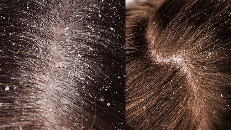 How To Banish Dandruff From Hair These Effective Methods To Try At