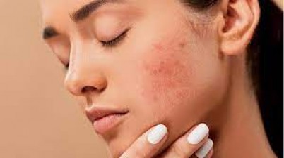 Pimples are spoiling the beauty of the face, do 5 such remedies at home, you will get benefit soon