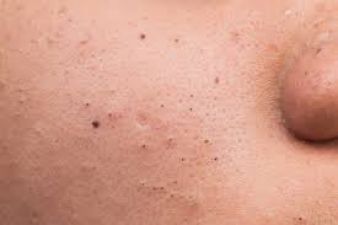 Having Blackheads: Try these homemade remedies