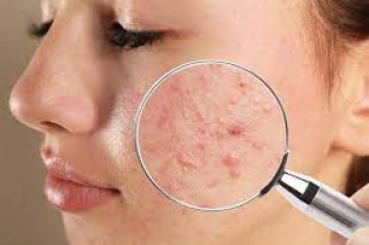 Do you also have acne frequently?