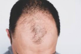 Male Baldness: Due to these 7 reasons men start becoming bald rapidly, do this work in time