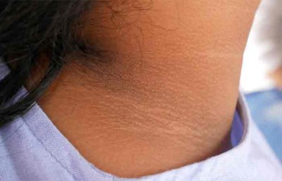 Has your neck turned black? Try these 5 easy remedies, you will get better results soon