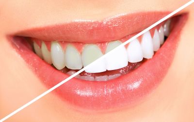 3 home remedies to whiten your teeth