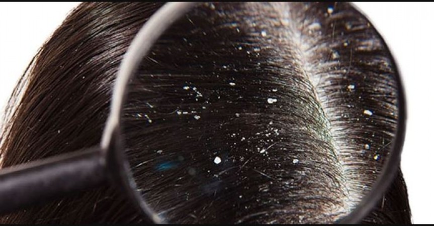 Can dandruff be cured by applying oil? Or is this the real root of the problem?