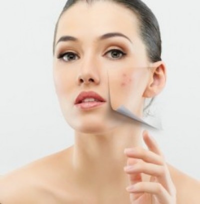 These 10 local things are helpful in reducing acne