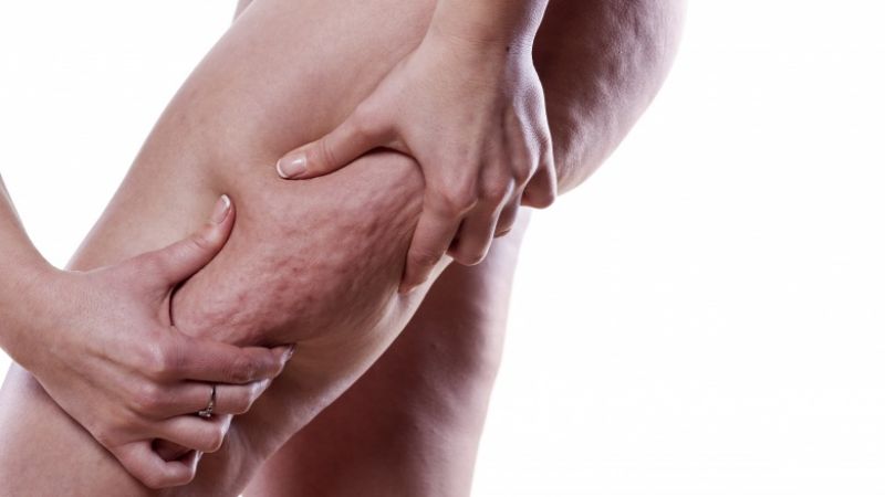 Get rid of stubborn cellulite while losing your weight