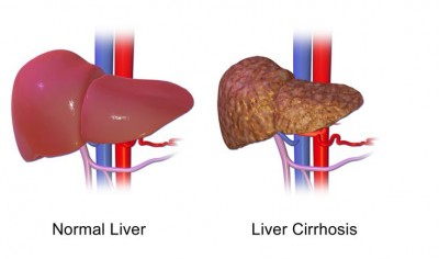World Liver Day April 19: Liver Cirrhosis, how to prevent