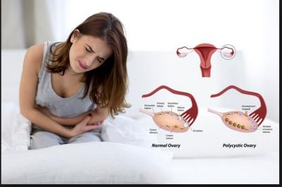 Ovarian cysts or PCOD is growing disease among young girl; Symptoms, causes and treatment