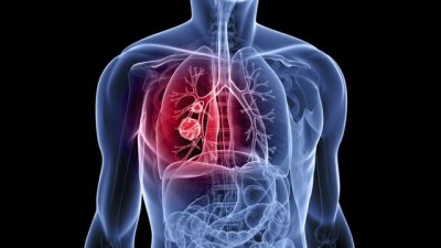 Lung cancer: All the Information You Need to Know