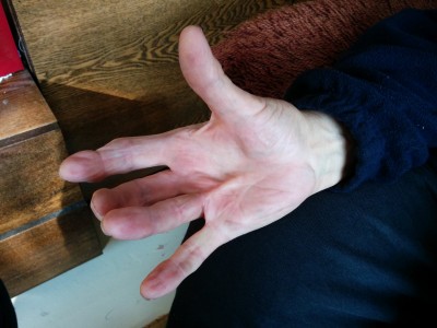 What Happens After Dupuytren's Contracture Surgery: A Comprehensive Guide