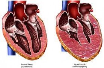 Managing Rare Cardiovascular Diseases: Insights into Treatment and Outlook
