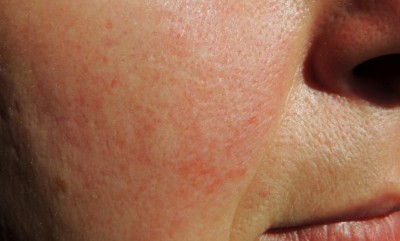 Warning Signs of Rosacea: What to Watch Out For