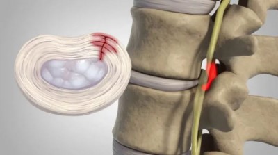 Warning Signs of a Herniated Disc: What to Watch for