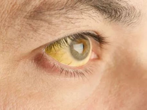 आंखों का पीलापन भी है पैंक्रियाटिक कैंसर का लक्षण, समय रहते पहचानें और करें बचाव