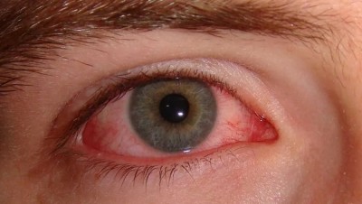 Understanding Red Eyes: Causes and Remedies for Conjunctivitis
