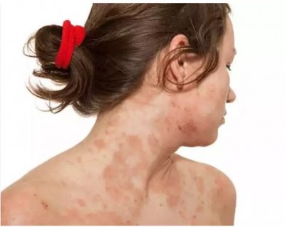 What is dermatitis, cases of which are increasing in winter?