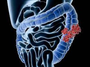 Colon cancer has started occurring in youth also, know its symptoms and precautions, it is important to be alert before time