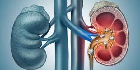 These symptoms indicate that you have a stone in your kidney