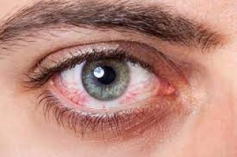If your eyes become red in winter then know the solution from the expert, you will get immediate relief