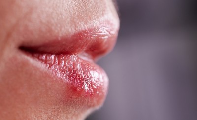 How to Manage Lip Pimples: Causes, Prevention, Treatment and More