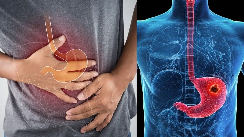 Looming crisis: Rising stomach cancer in India